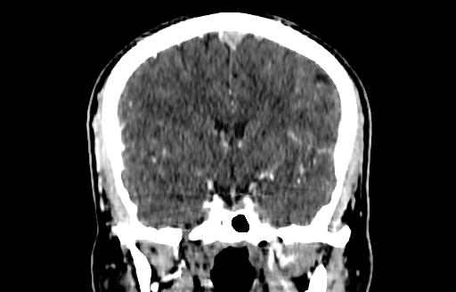Cerebral venous thrombosis (CVT) (Radiopaedia 77524-89685 C 28).jpg