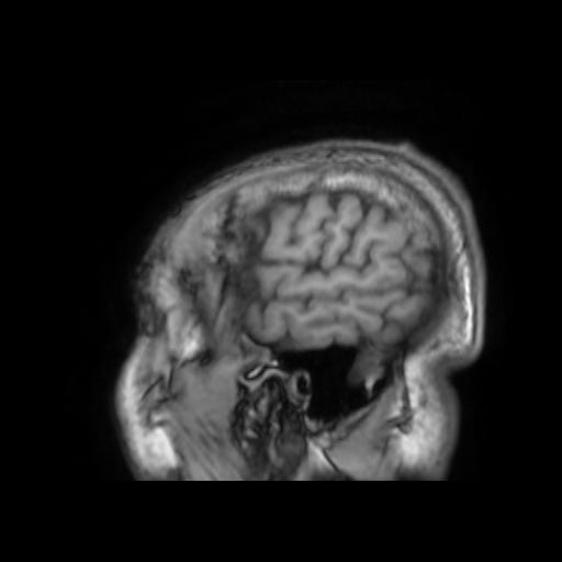 File:Cerebral venous thrombosis with secondary intracranial hypertension (Radiopaedia 89842-106957 Sagittal T1 27).jpg