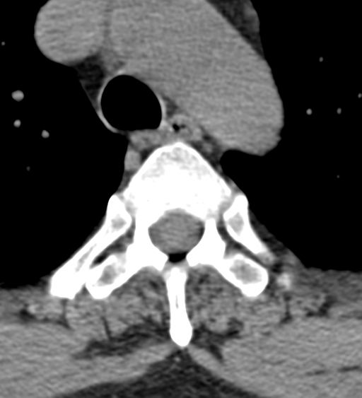 File:Cervical canal stenosis due to ossification of the posterior longitudinal ligament (Radiopaedia 47260-51823 Axial non-contrast 72).png