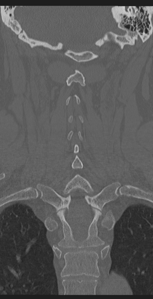 Cervical canal stenosis due to ossification of the posterior longitudinal ligament (Radiopaedia 47260-51823 Coronal bone window 42).png