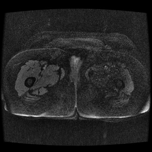 Cervical carcinoma (Radiopaedia 70924-81132 Axial T1 C+ fat sat 177).jpg
