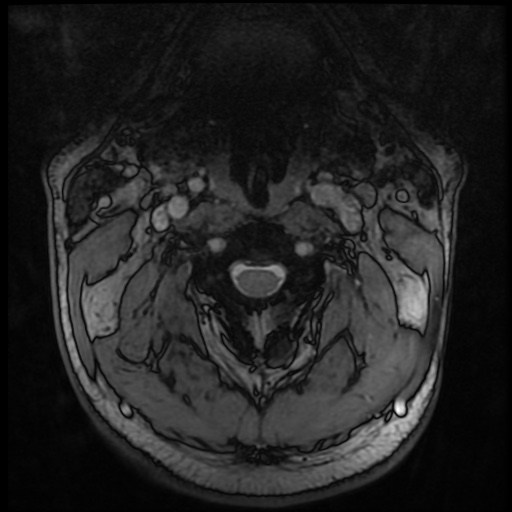 Cervical disc extrusion (Radiopaedia 59074-66364 G 14).jpg