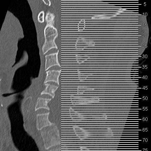 Cervical spinal neurofibroma in a patient with NF1 (Radiopaedia 58344-65464 Axial bone window 1).jpg