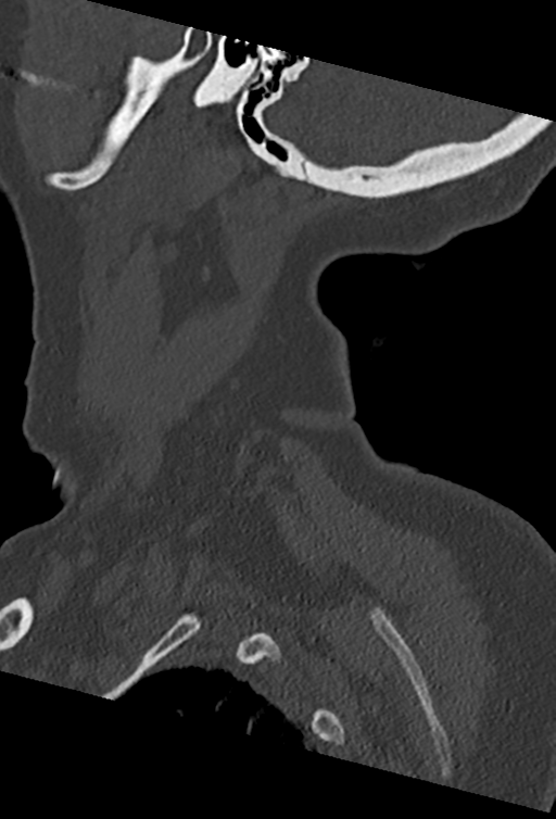 Cervical spine ACDF loosening (Radiopaedia 48998-54070 Sagittal bone window 13).png