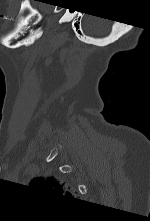 Cervical spine ACDF loosening (Radiopaedia 48998-54070 Sagittal bone window 72).png