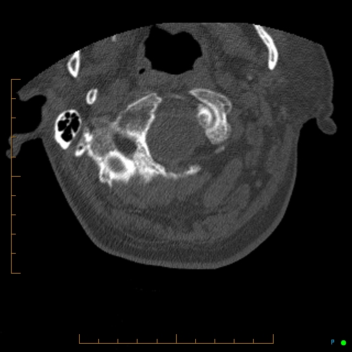 File:Cervical spine fracture - ankylosing spondylitis (Radiopaedia 76835-88706 Axial bone window 15).jpg