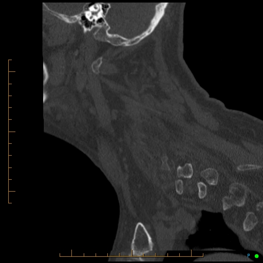 Cervical spine fracture - ankylosing spondylitis (Radiopaedia 76835-88706 Sagittal bone window 24).jpg