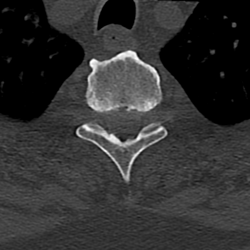 File:Cervical spine fracture - chalk stick (Radiopaedia 39116-41323 Axial bone window 96).png
