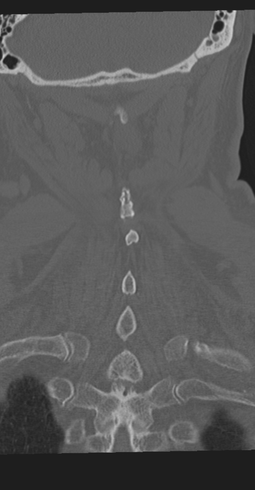 Cervical spine fracture in the setting of ankylosis (Radiopaedia 37038-38715 Coronal bone window 57).png