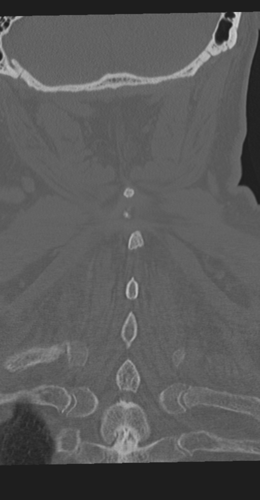 Cervical spine fracture in the setting of ankylosis (Radiopaedia 37038-38715 Coronal bone window 59).png