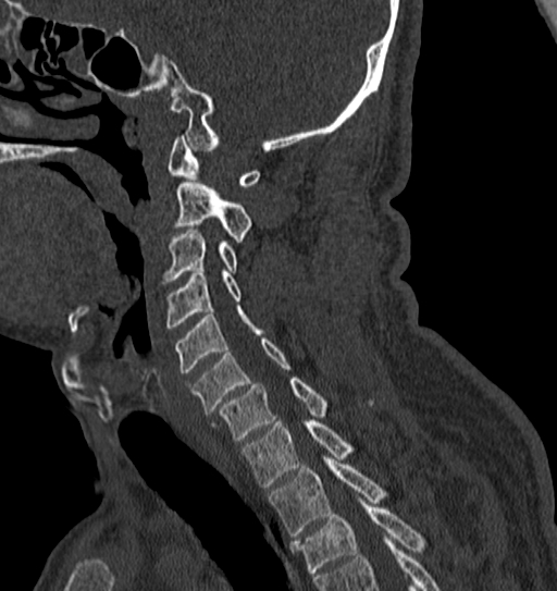 Cervical spine trauma with tear drop fracture and perched facet joint (Radiopaedia 53989-60127 Sagittal bone window 60).jpg