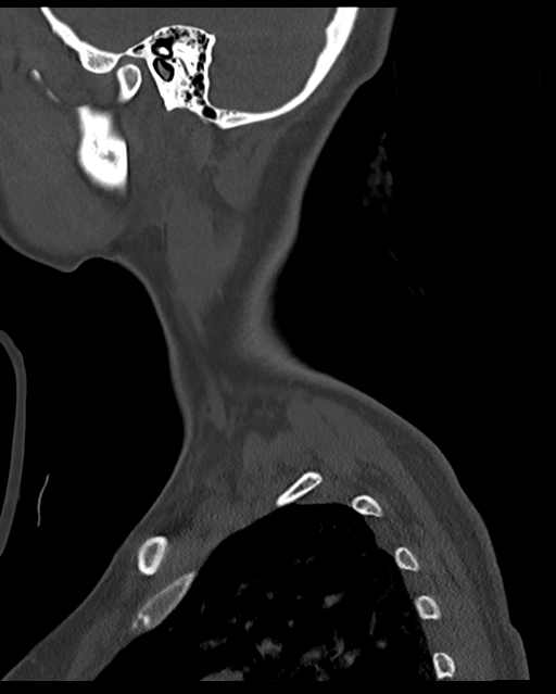 Cervical tuberculous spondylitis (Radiopaedia 39149-41365 Sagittal bone window 64).png