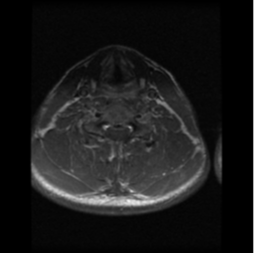 File:Cervical vertebrae metastasis (Radiopaedia 78814-91667 Axial T1 C+ 6).png
