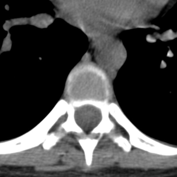Chance fracture (Radiopaedia 36521-38081 Axial non-contrast 15).jpg