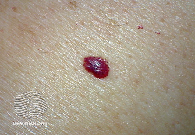 File:Cherry angioma 4 macro (DermNet NZ 152889).jpg