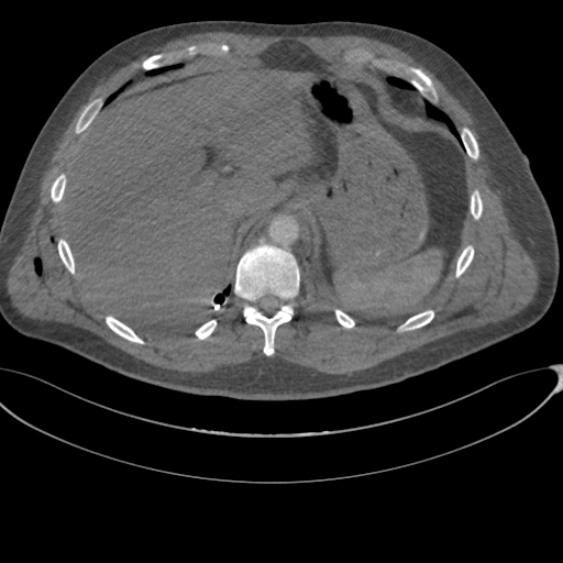 File:Chest multitrauma - aortic injury (Radiopaedia 34708-36147 A 268).png