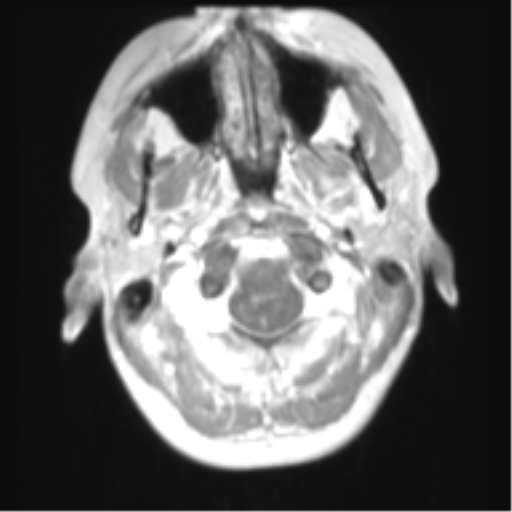 File:Chiari I malformation and obstructive hydrocephalus (Radiopaedia 41185-43978 Axial T1 C+ 5).png