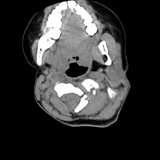Chiari I with syrinx and skull base anomalies (Radiopaedia 89444-106412 Axial non-contrast 58).jpg