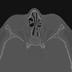 Choanal atresia (Radiopaedia 88525-105975 Axial bone window 80).jpg