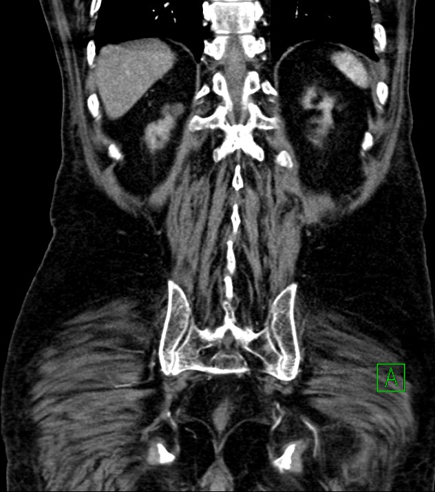 Cholangiocarcinoma with cerebral metastases (Radiopaedia 83519-98629 E 71).jpg