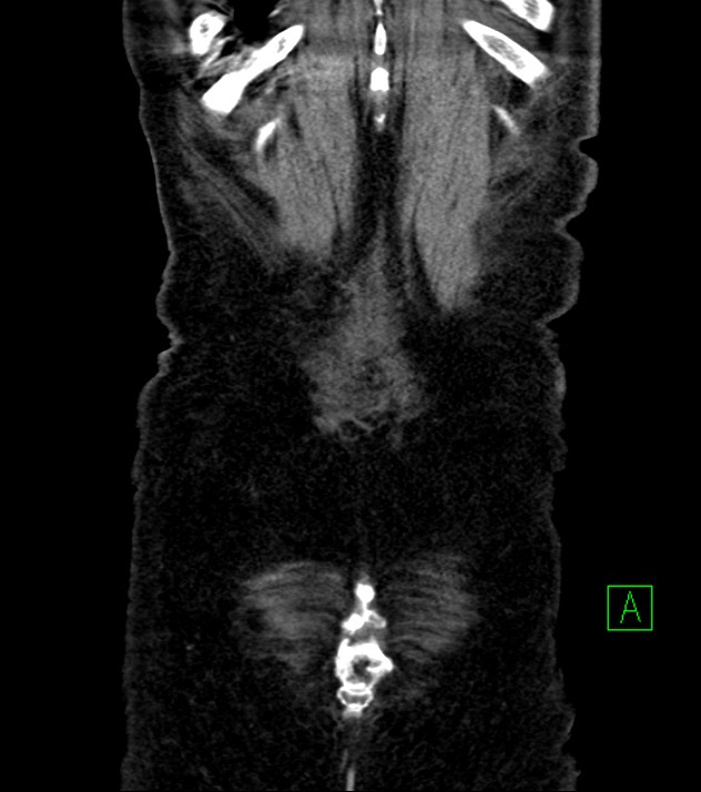 Cholangiocarcinoma with cerebral metastases (Radiopaedia 83519-98629 E 83).jpg