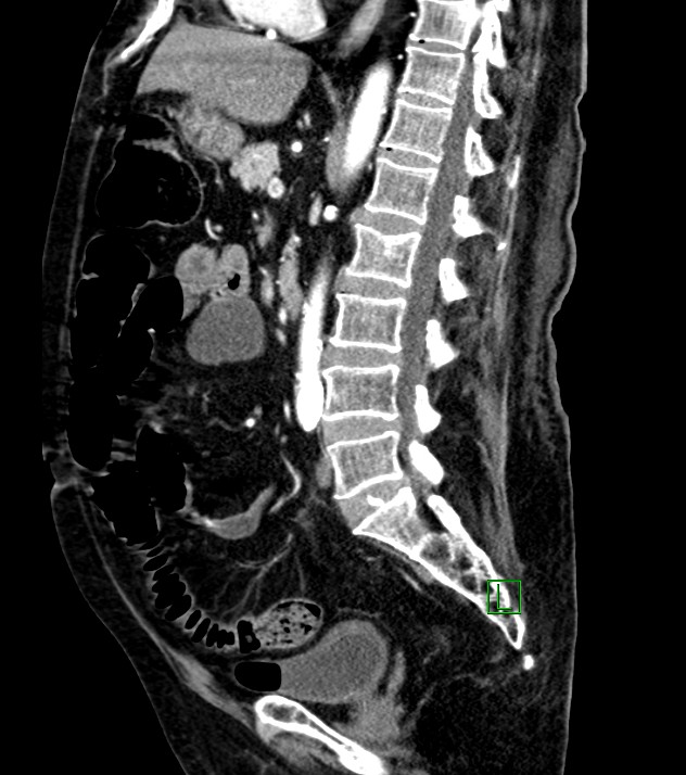 Cholangiocarcinoma with cerebral metastases (Radiopaedia 83519-98629 F 60).jpg