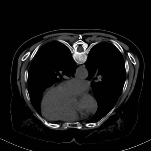 File:Cholecystitis - obstructive choledocholitiasis (CT intravenous cholangiography) (Radiopaedia 43966-47479 Axial 79).png