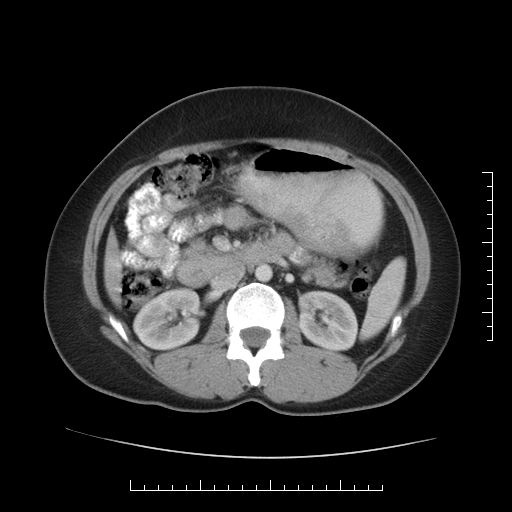 File:Choledochal cyst with chronic calcific pancreatitis (Radiopaedia 18245-18061 A 17).png