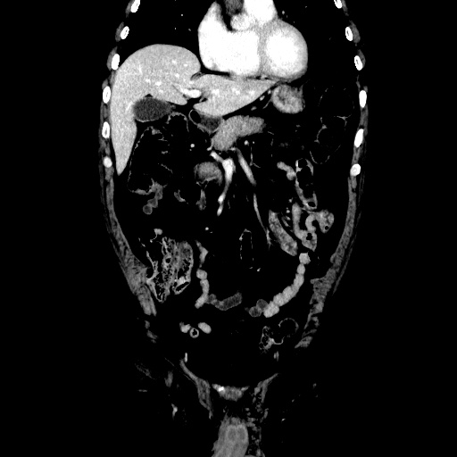 Choledocholiathiasis with normal caliber common bile duct (Radiopaedia 75368-86632 Coronal liver window 45).jpg