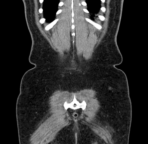 Choledocholithiasis on CT and MRI (Radiopaedia 24825-25087 C 50).jpg