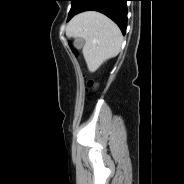 Choledocholithiasis on CT and MRI (Radiopaedia 24825-25087 D 13).jpg