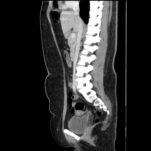Choledocholithiasis on CT and MRI (Radiopaedia 24825-25087 D 30).jpg