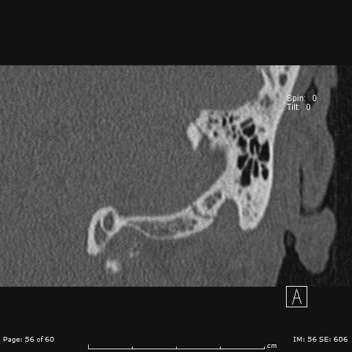 Cholesteatoma - external auditory canal (Radiopaedia 88452-105096 Coronal bone window 56).jpg