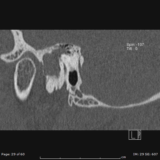 Cholesteatoma - external auditory canal (Radiopaedia 88452-105096 Sagittal bone window 29).jpg