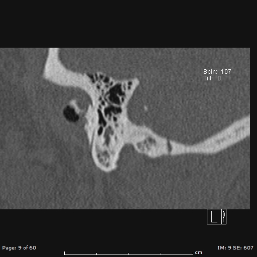 Cholesteatoma - external auditory canal (Radiopaedia 88452-105096 Sagittal bone window 9).jpg