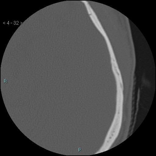 File:Cholesterol granuloma of the petrous apex (Radiopaedia 64358-73141 Axial bone window 16).jpg