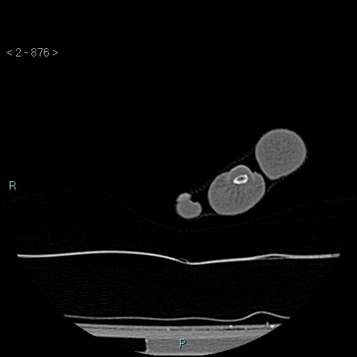 Chondrosarcoma - phalanx (Radiopaedia 69047-78812 Axial bone window 130).jpg