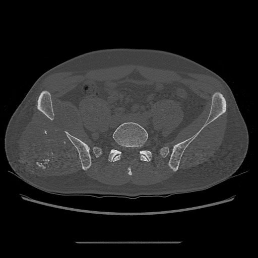 File:Chondrosarcoma of iliac wing (Radiopaedia 63861-72599 Axial bone window 46).jpg