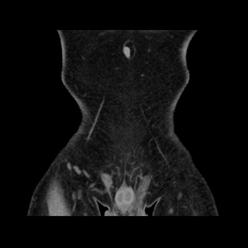 Chondrosarcoma of iliac wing (Radiopaedia 63861-72599 Coronal non-contrast 19).jpg