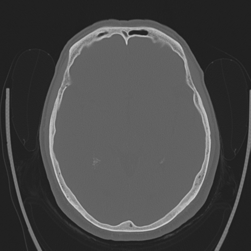 Chondrosarcoma of skull base- grade II (Radiopaedia 40948-43653 Axial bone window 22).png