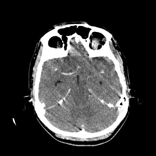 File:Choriocarcinoma of ovary with cerebral and pulmonary metastases (Radiopaedia 25983-26118 C+ arterial phase 54).jpg