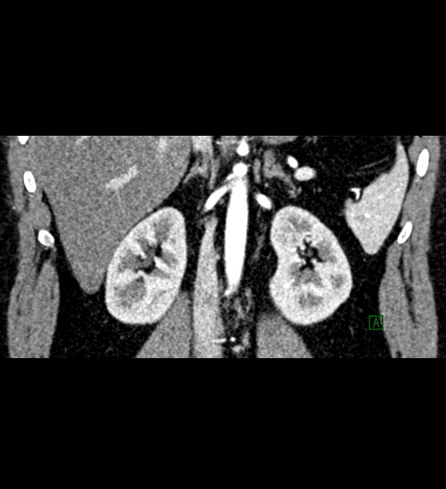 Chromophobe renal cell carcinoma (Radiopaedia 84286-99573 E 49).jpg