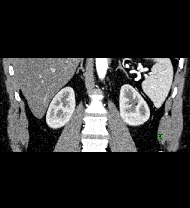 Chromophobe renal cell carcinoma (Radiopaedia 84286-99573 E 59).jpg