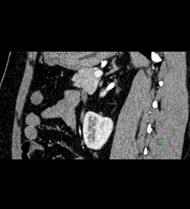 Chromophobe renal cell carcinoma (Radiopaedia 84286-99573 F 63).jpg