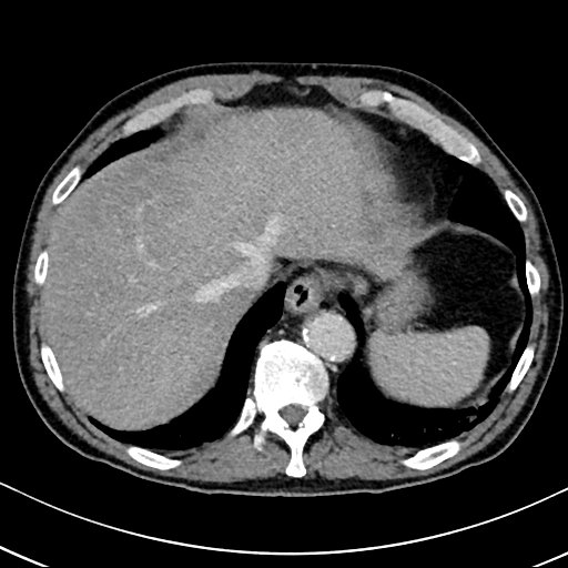 Chronic appendicitis complicated by appendicular abscess, pylephlebitis and liver abscess (Radiopaedia 54483-60700 B 29).jpg