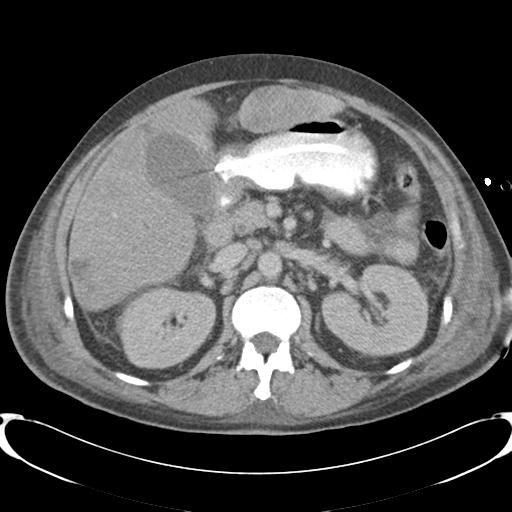 Chronic diverticulitis complicated by hepatic abscess and portal vein thrombosis (Radiopaedia 30301-30938 A 38).jpg