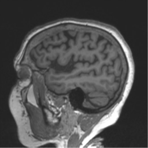 File:Chronic hypertensive encephalopathy (Radiopaedia 39993-42482 Sagittal T1 72).png
