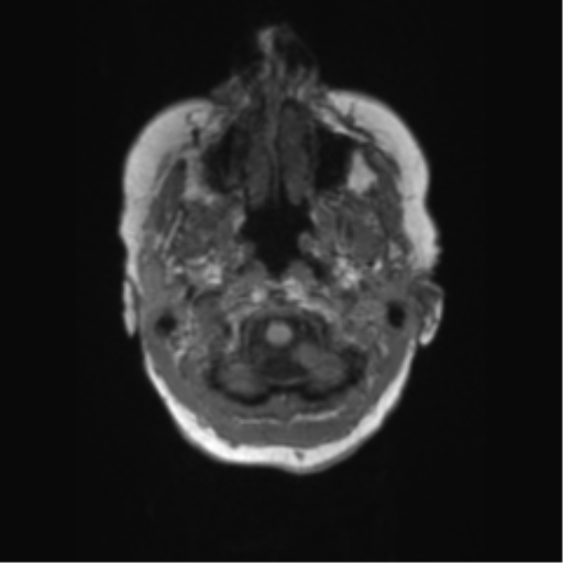 Chronic hypertensive encephalopathy (Radiopaedia 72844-83495 Axial T1 67).png