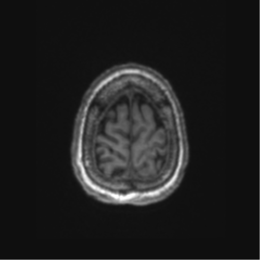 Chronic hypertensive encephalopathy (Radiopaedia 72844-83495 Axial T1 9).png