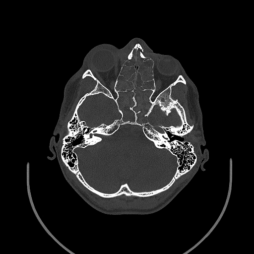 Chronic invasive fungal sinusitis (Radiopaedia 50342-55710 Axial bone window 68).jpg